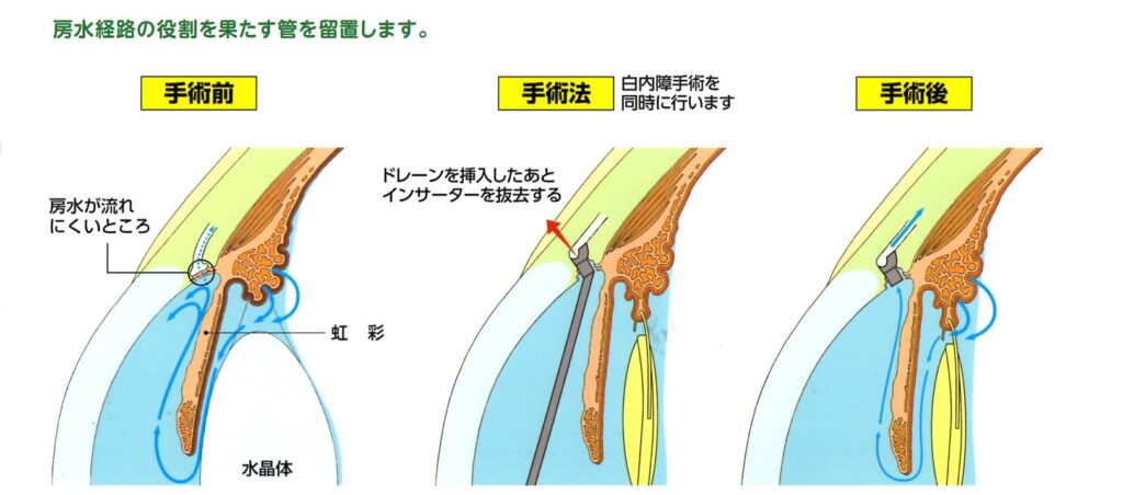 白内障手術併用眼内ドレーン挿入術（アイステント）