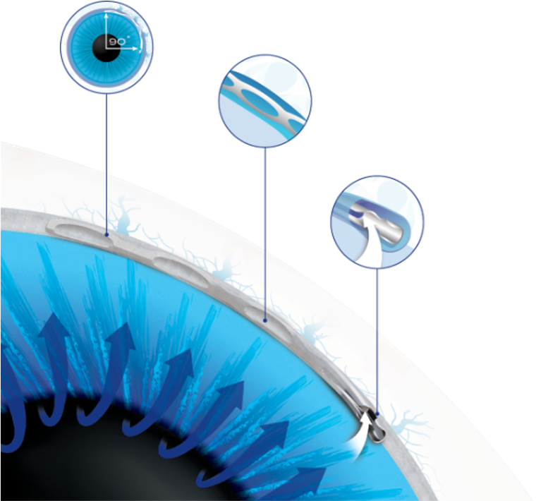 白内障手術併用眼内ドレーン挿入術