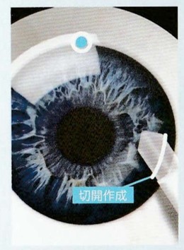 眼に麻酔をした後、ナイフを用いて ハイドラスマイクロステントを 挿入する切開を作成します。