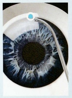 作成した切開からハイドラス マイクロステントを眼内（シュレム管）へ 挿入します。