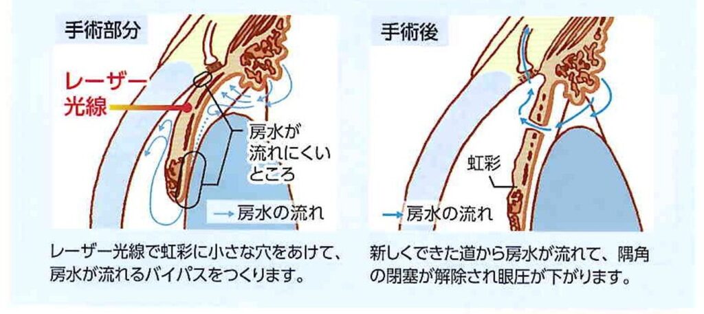 レーザー虹彩切開術(LI)
