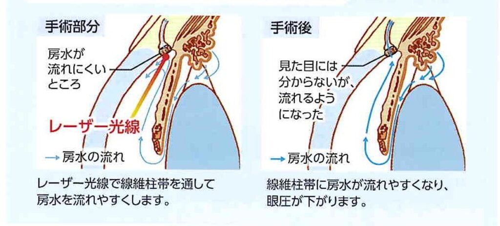 選択的レーザー線維柱帯形成術(SLT)