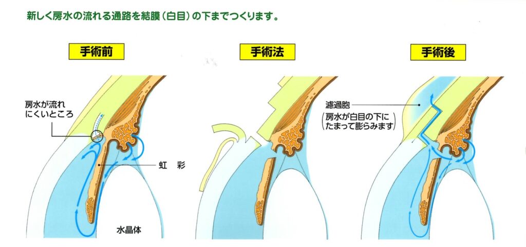 線維柱帯切除術（ロトミー）