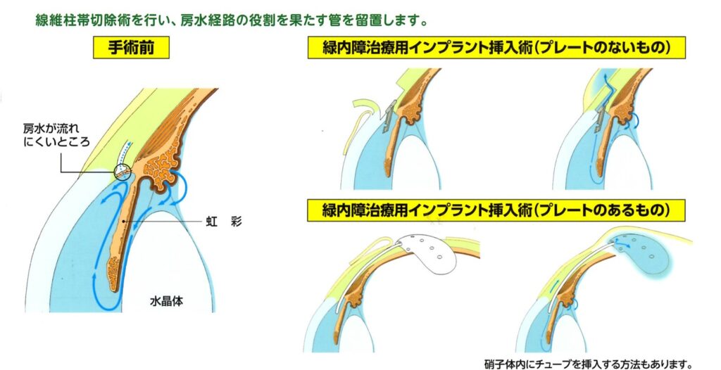 チューブシャント手術