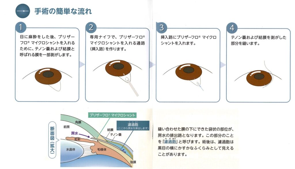 プリザーフロマイクロシャント手術