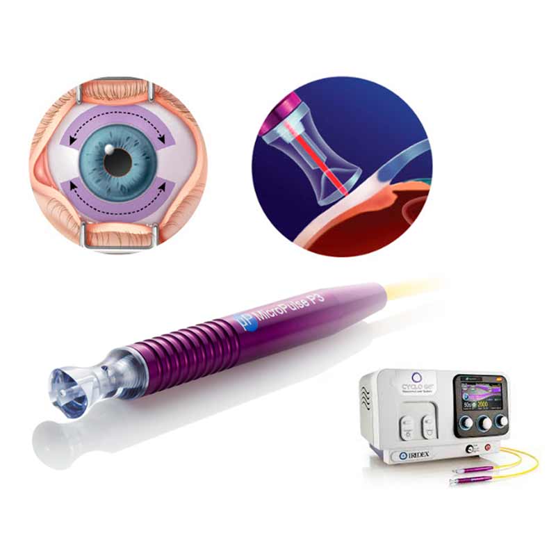 マイクロパルス毛様体光凝固術