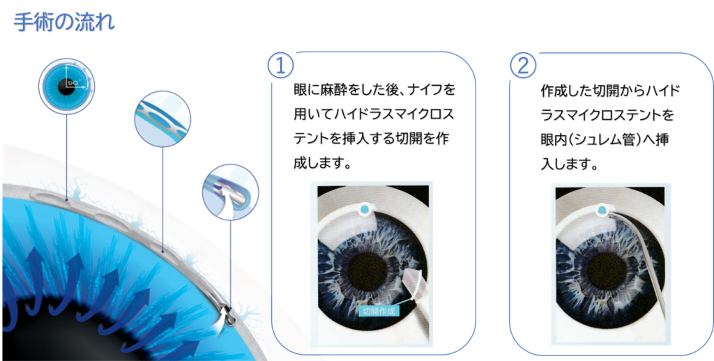 白内障手術併用眼内ドレーン挿入術（ハイドラス）