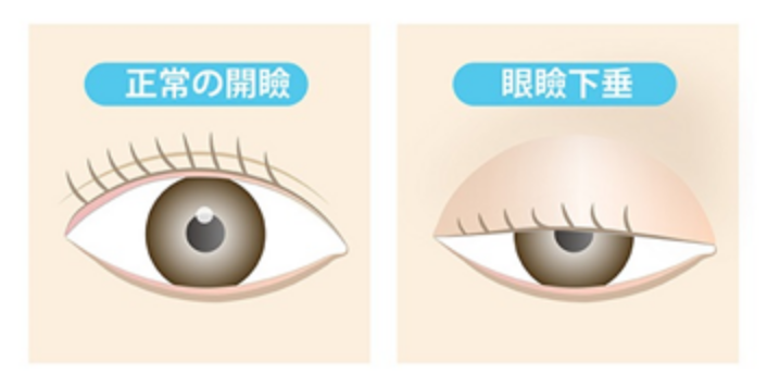 眼瞼下垂手術について
