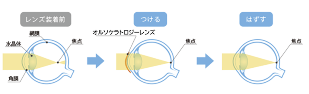 オルソケラトロジーの仕組み