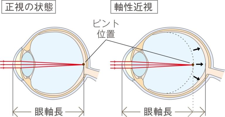 子どもの近視について