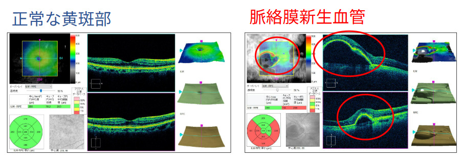 加齢黄斑変性症