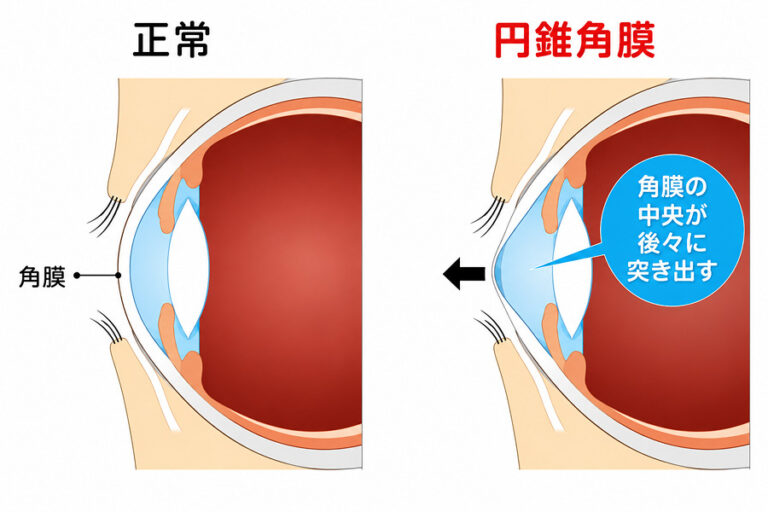 円錐角膜とは